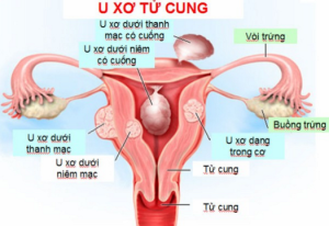 U sơ tử cung