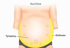 xơ gan cổ trướng