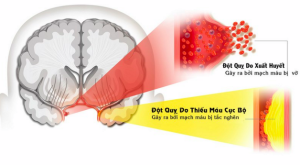 chữa tai biến mạch máu não