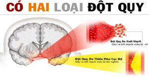 chữa đột quỵ