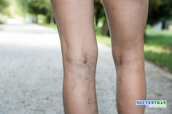 dấu hiệu cảnh báo đột quỵ 4