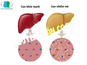 Dấu hiệu gan nhiễm mỡ