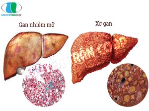 dấu hiệu nhận biết gan nhiễm mỡ