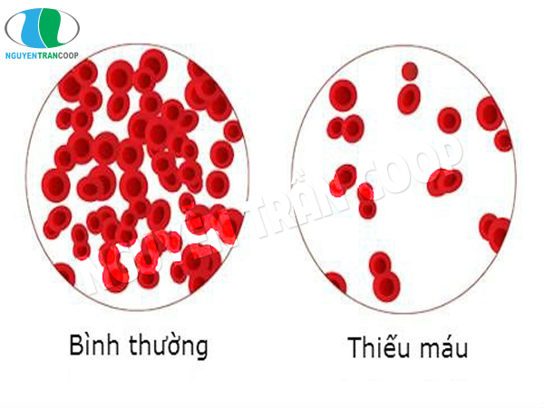 Bạn đã có thể phòng ngừa thiếu máu bằng Nấm Lim Xanh