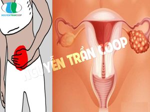 Cảnh báo những dấu hiệu ung thư buồng trứng chị em nên biết