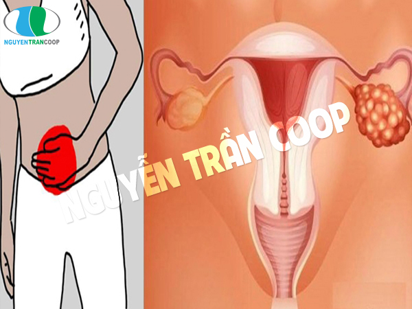 Những dấu hiệu ung thư buồng trứng chị em nên biết