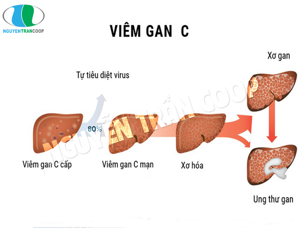 Điều trị viêm gan C như thế nào là hiệu quả?