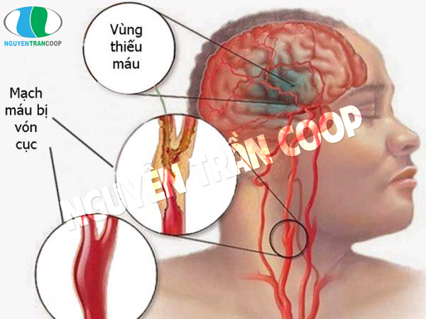Rối loạn tuần hoàn não có nguy hiểm không?