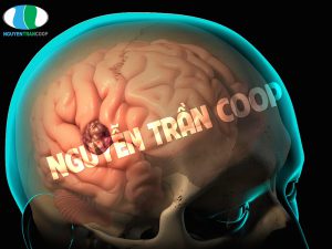 Rối loạn tuần hoàn não có nguy hiểm không?