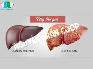 Thực hư tác dụng Xáo Tam Phân chữa ung thư gan?