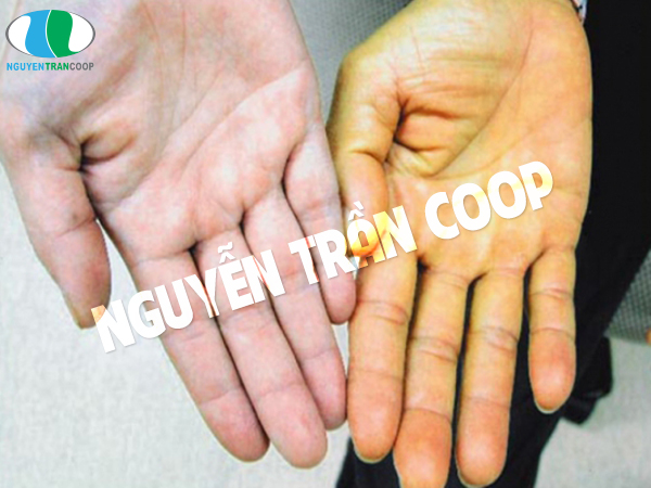 5 biểu hiện bệnh gan qua da dễ nhận biết