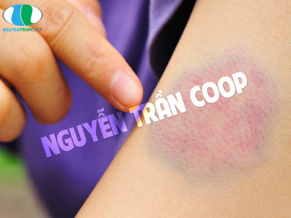 5 biểu hiện bệnh gan qua da dễ nhận biết