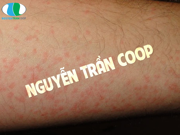 5 biểu hiện bệnh gan qua da dễ nhận biết