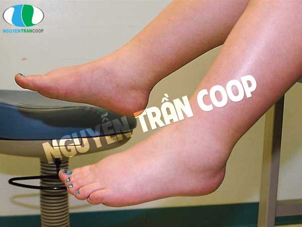 5 biểu hiện bệnh gan qua da dễ nhận biết