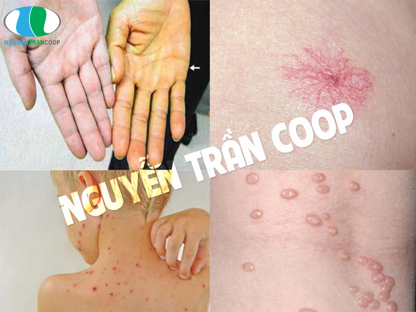 Bệnh gan là gì? Mắc bệnh gan có còn cơ hội cứu chữa được không?