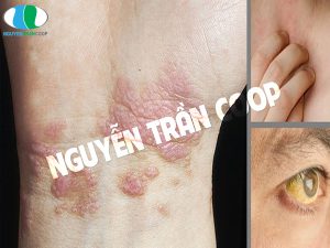 Những biểu hiện của người bị bệnh gan