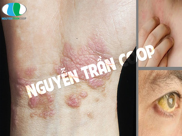 Những biểu hiện của người bị bệnh gan 1