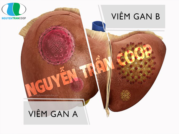Triệu chứng của bệnh viêm gan 1