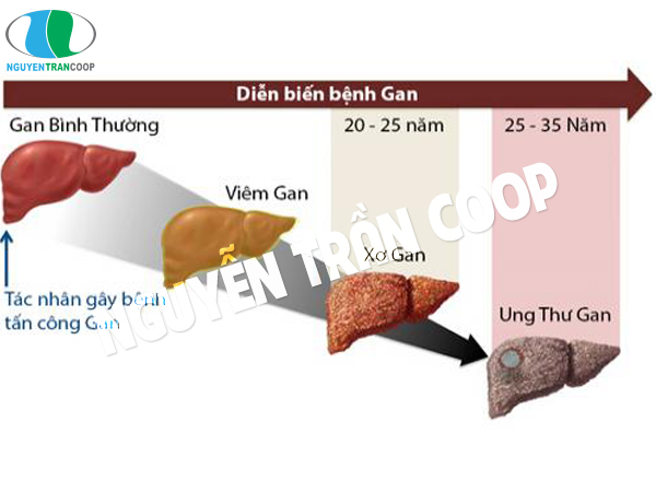 Bệnh xơ gan 1