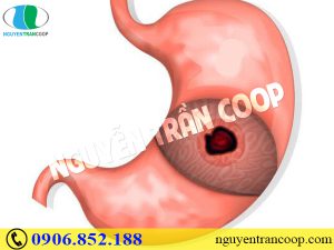 Bị thủng dạ dày có thật hay không?