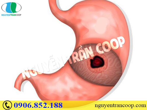 Bị thủng dạ dày có thật hay không?