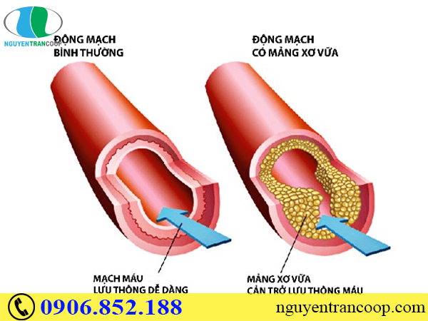 Nấm Lim Xanh giảm mỡ máu cao - Thảo dược tốt cho người lớn tuổi