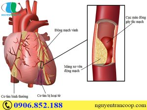 Nấm Lim Xanh giảm mỡ máu cao - Thảo dược tốt cho người lớn tuổi