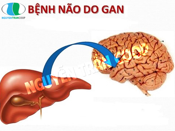 Nguy hiểm không ngờ từ bệnh não gan (hôn mê gan)