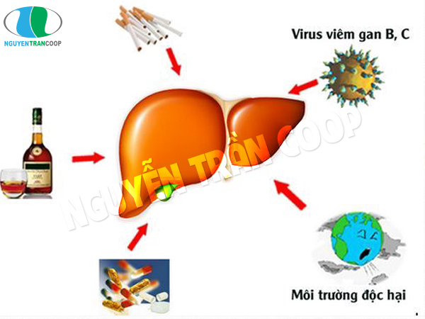 Nguy hiểm không ngờ từ bệnh não gan (hôn mê gan)