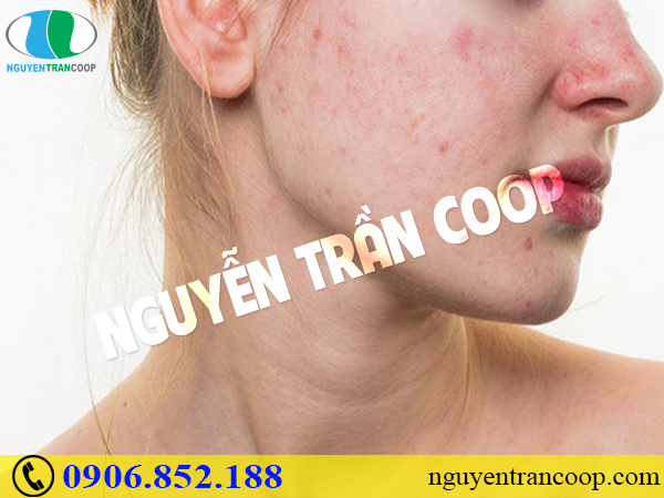 Nguyên nhân gây mụn - Không biết thì làm sao hết mụn!