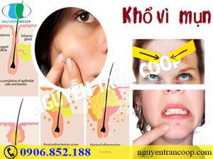 Nguyên nhân gây mụn - Không biết thì làm sao hết mụn!