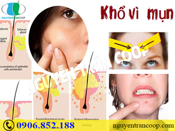 Nguyên nhân gây mụn - Không biết thì làm sao hết mụn!