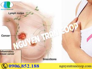 Những quan niệm “ngây ngô” về bệnh ung thư vú