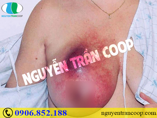 Những quan niệm “ngây ngô” về bệnh ung thư vú