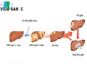 Những thông tin bạn cần biết về bệnh viêm gan C