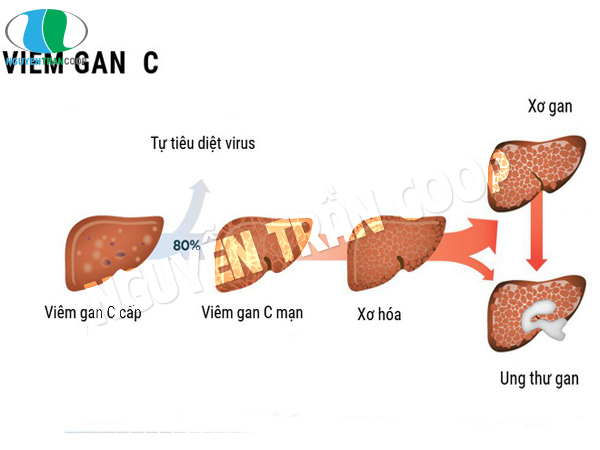 Những thông tin bạn cần biết về bệnh viêm gan C