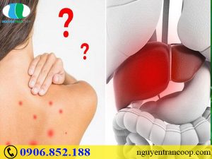 Triệu chứng suy giảm chức năng gan có dễ nhận biết?