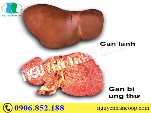 Ung thư gan có chữa khỏi không? Cơ hội là bao nhiêu?