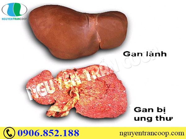 Ung thư gan có chữa khỏi không? Cơ hội là bao nhiêu?