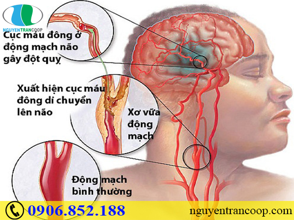 Xơ vữa động mạch - Căn bệnh âm thầm không thể coi thường
