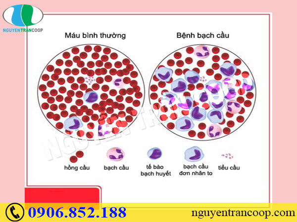 Bài thuốc Tam Thất Bắc và bệnh ung thư máu
