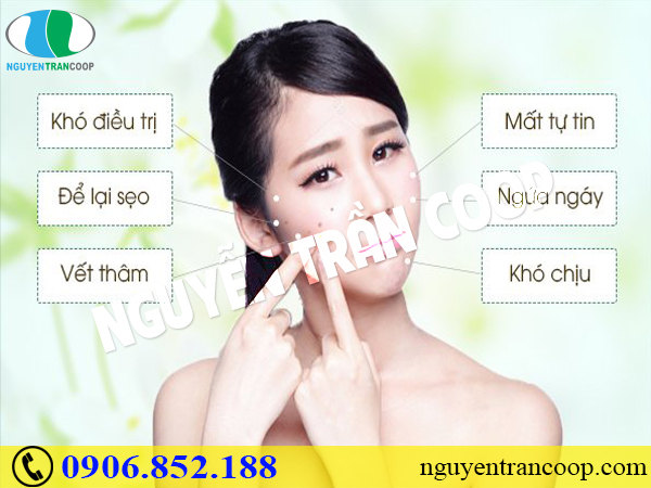 Các cách trị mụn tuổi dậy thì và ngăn mụn tái phát
