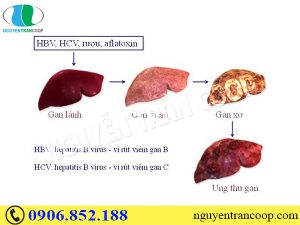 Có bao nhiêu giai đoạn ung thư gan? Biểu hiện như thế nào?