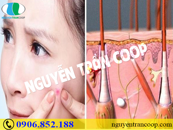 Da mịn màng hơn nhờ cách trị thâm mụn hiệu quả