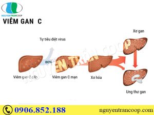 Điều trị viêm gan C mãn tính cần chú ý điều gì?