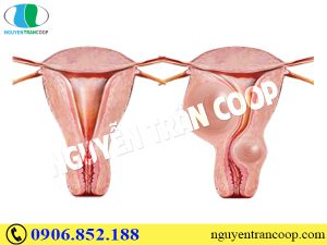 Dùng thảo dược nào để hỗ trợ điều trị u xơ tử cung?