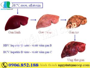 Hy vọng cho người bệnh chữa ung thư gan giai đoạn cuối