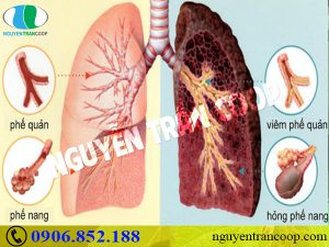 Không chỉ hại phổi, hút thuốc lá còn gây bệnh gan