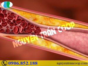 Nấm Lim Xanh chữa máu nhiễm mỡ có tốt không?