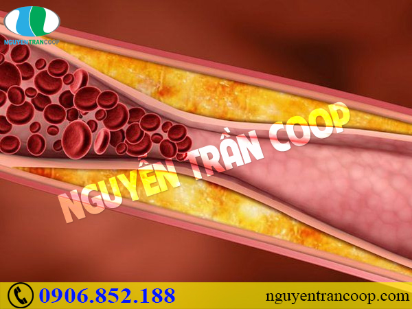 Nấm Lim Xanh chữa máu nhiễm mỡ có tốt không?